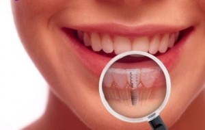Implantul dentar – lucruri esentiale  pe care ar trebui sa le stii